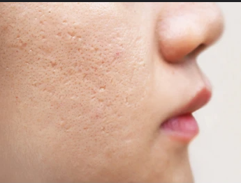 Image of Ice Pick Acne Scars