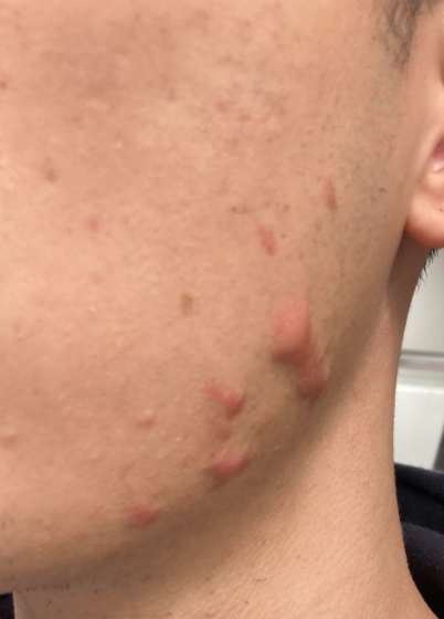 Image of Keloid Acne Scars