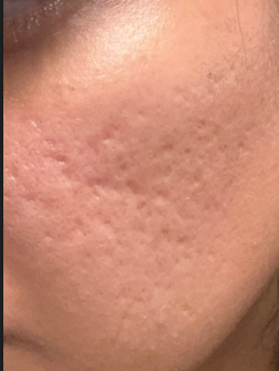 Image of Rolling Acne Scars