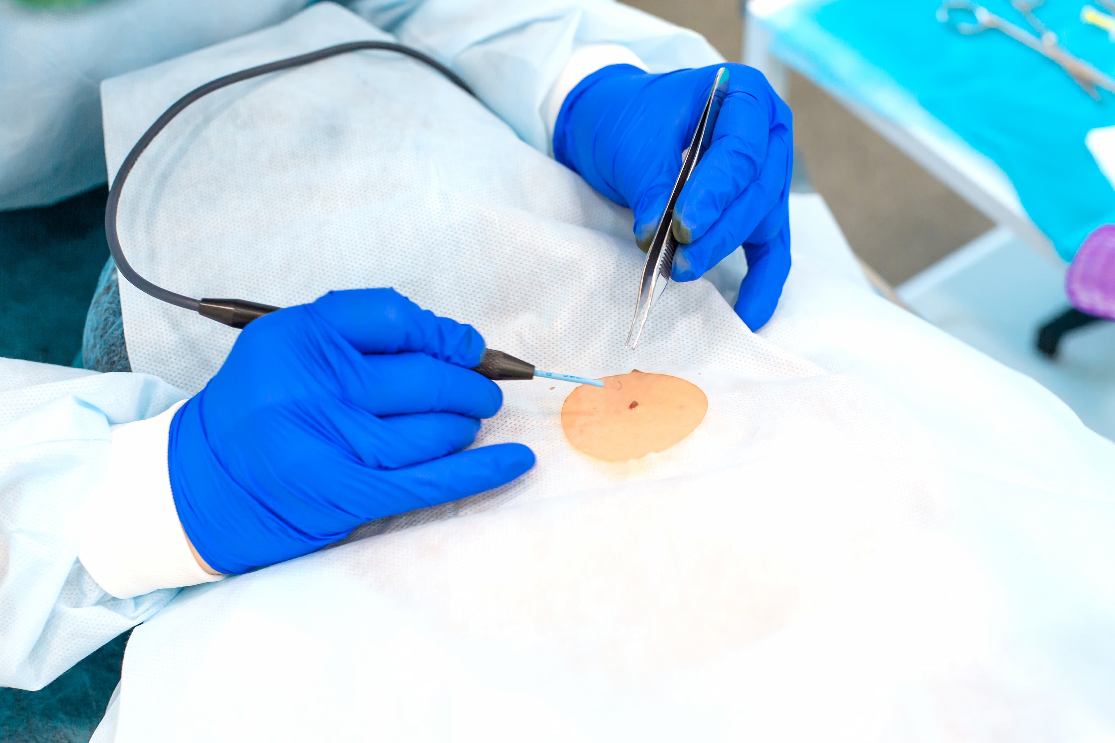 Subcision Acne Scar Treatment