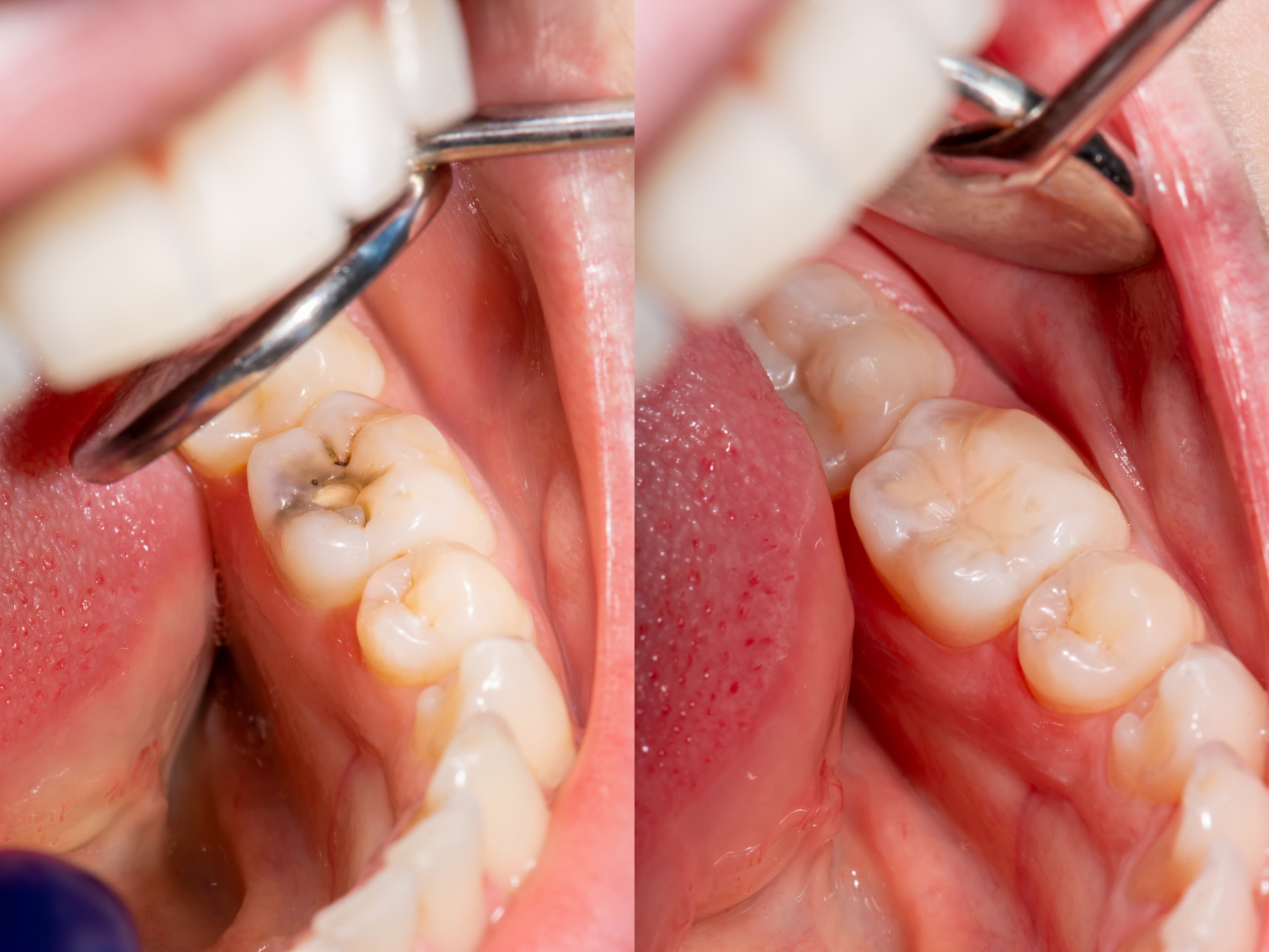 Composite Filling